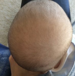 Our Journey with Plagiocephaly, or Flat Head Syndrome | Duluth Moms Blog