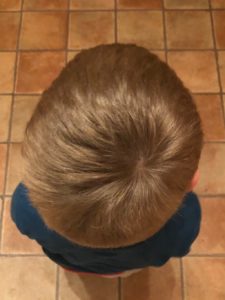 Our Journey with Plagiocephaly, or Flat Head Syndrome | Duluth Moms Blog